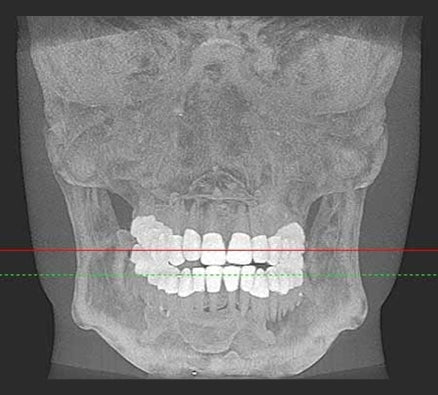 Maxillofacial Phantom Head & Dental X-Ray Cone Beam CT Panoramic Complete