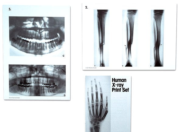 Human X-Rays Dental, Body Skeletal Bones Intestine Foot Arm Hip