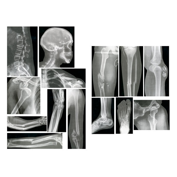 Human Broken Bones X-Ray Images Photos 15 Set