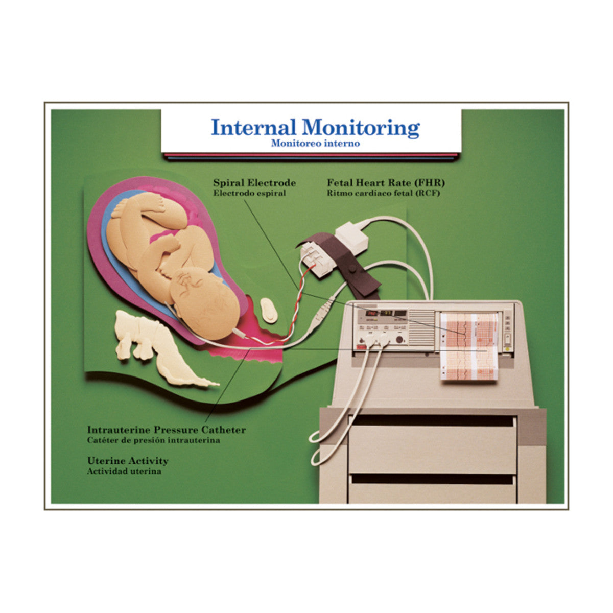 Labor Birth Intervention Charts St of 6